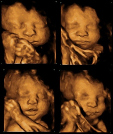 Four Ultrasounds